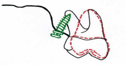 miniimplantat