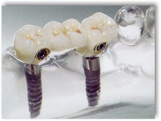 implantatbrücke